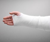 Treatment for Bone Fractures
